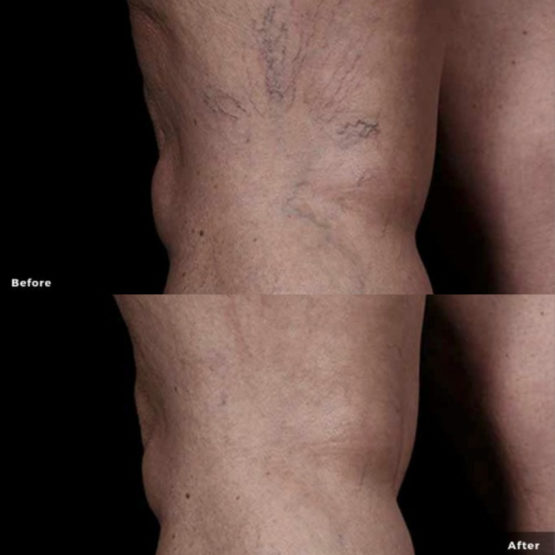 CUTERA Xeo Vein Therapy