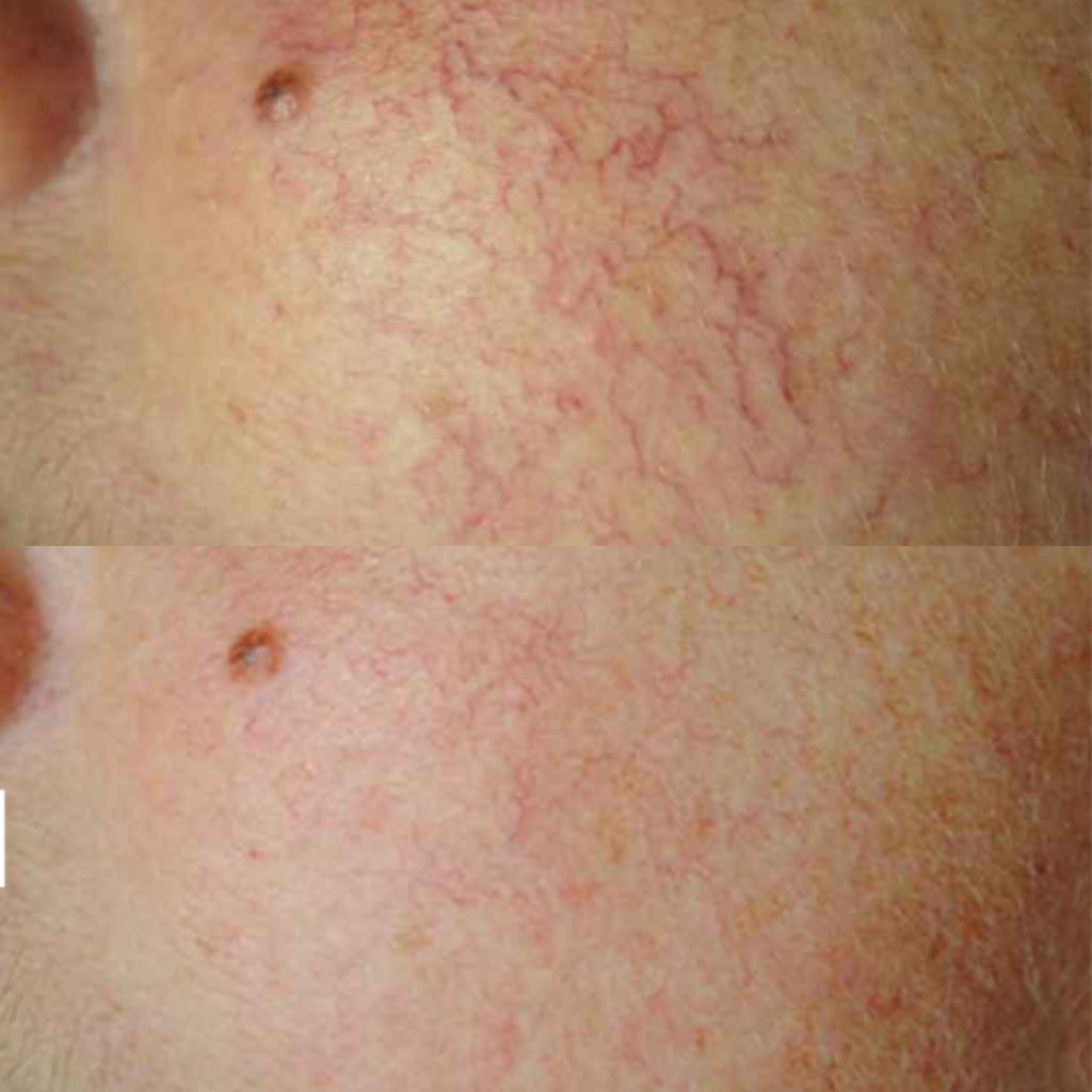 CUTERA Xeo Vein Therapy 3 CUTERA Xeo Vein Therapy 3
