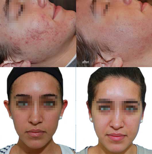 REFORM Skincare Professional Peels