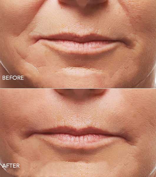 derma-fillers Dermal Fillers