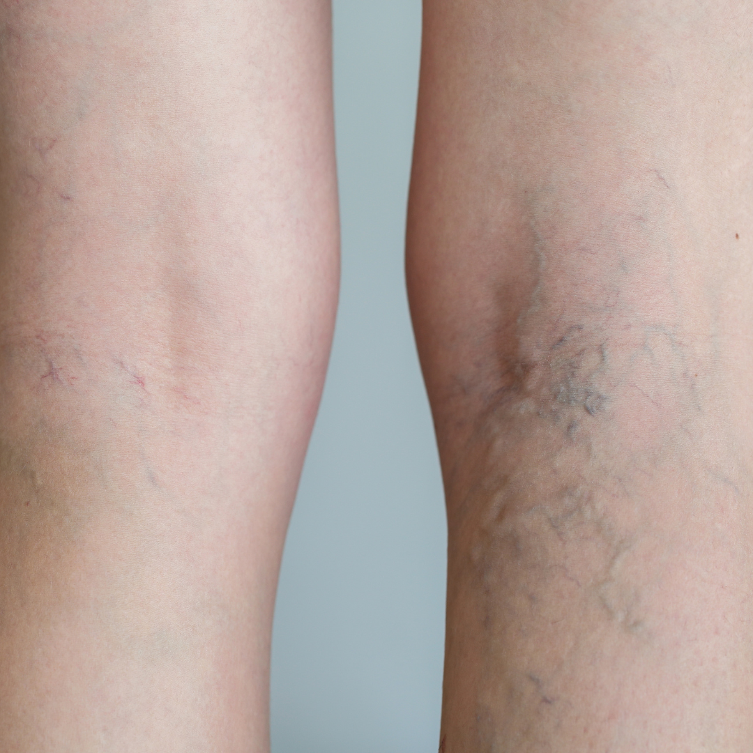 Untitled design (63) thread veins