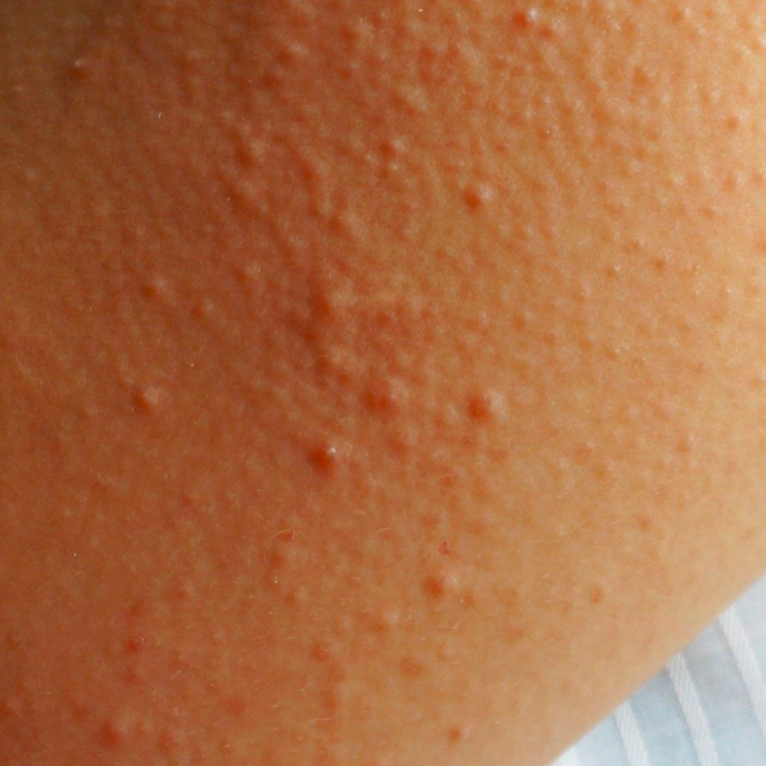 Keratosis Pilaris